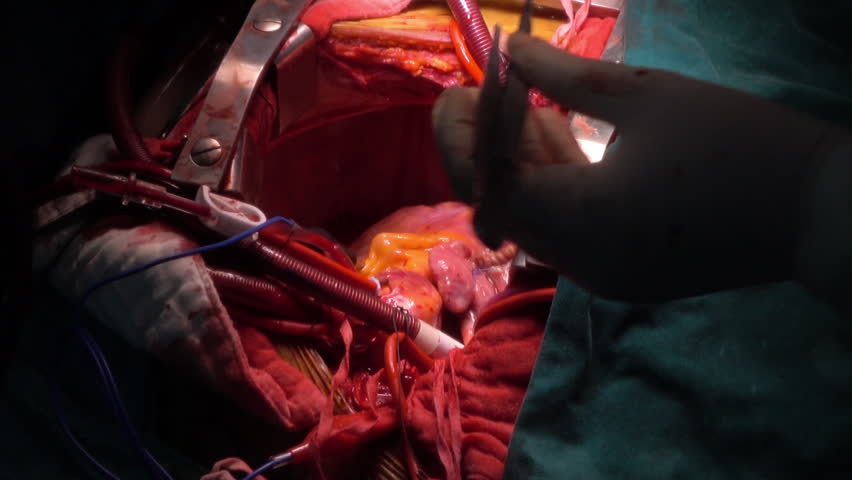 Open Heart Surgery Video Download